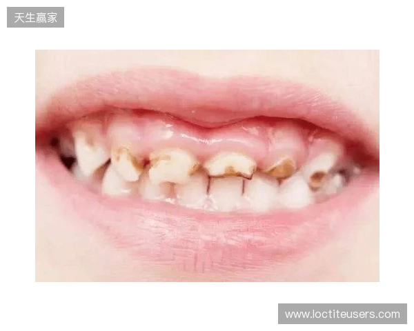 韦林顿确诊上唇部贯通伤;11、21牙半脱位;上颌前牙区牙槽骨骨折